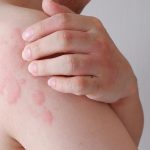 Svrbive vyrazky sa objavia v priebehu minut Chlad moze vyvolat aj zivot ohrozujuocu reakciu