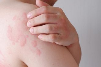 Svrbive vyrazky sa objavia v priebehu minut Chlad moze vyvolat aj zivot ohrozujuocu reakciu