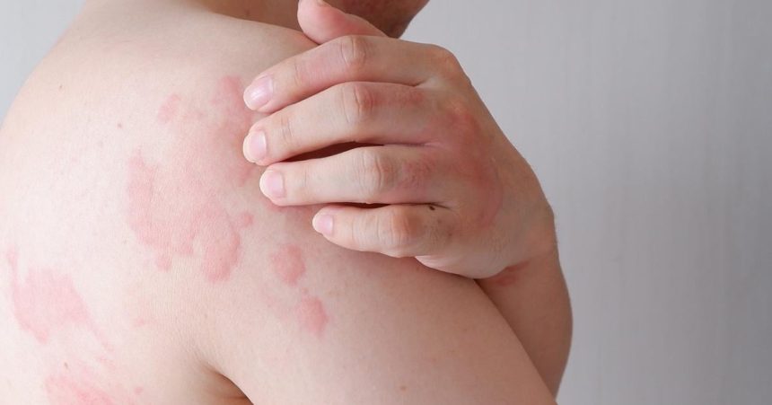 Svrbive vyrazky sa objavia v priebehu minut Chlad moze vyvolat aj zivot ohrozujuocu reakciu