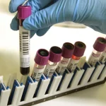 V obci vypukla infekčná choroba. Hygienici nariadili očkovanie